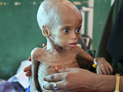 Acutely malnourished child Sacdiyo Mohamed, 9 months old, is treated at Banadir hospital in Somalia on Saturday. Somalia's government has declared the drought there a national disaster. Mohamed Sheikh Nor/AP