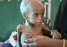 Acutely malnourished child Sacdiyo Mohamed, 9 months old, is treated at Banadir hospital in Somalia on Saturday. Somalia's government has declared the drought there a national disaster. Mohamed Sheikh Nor/AP